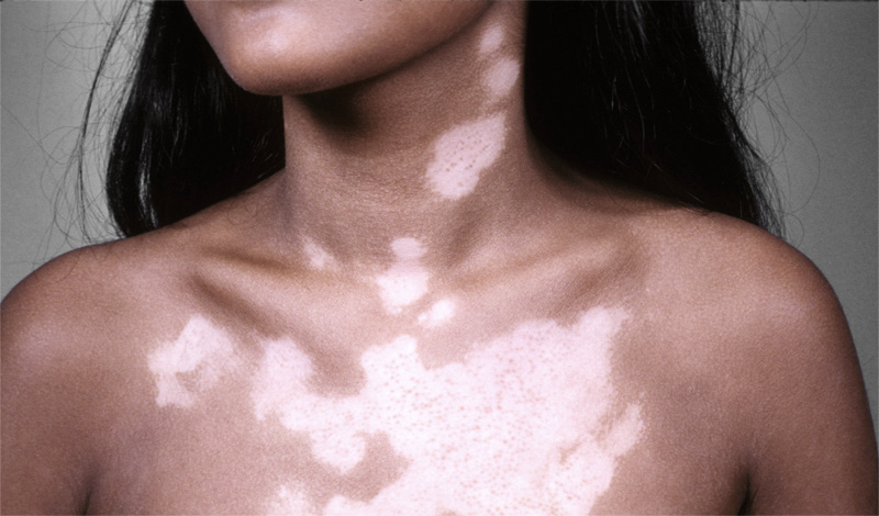 Skin Conditions Quiz: Common Skin Disorders & Diseases